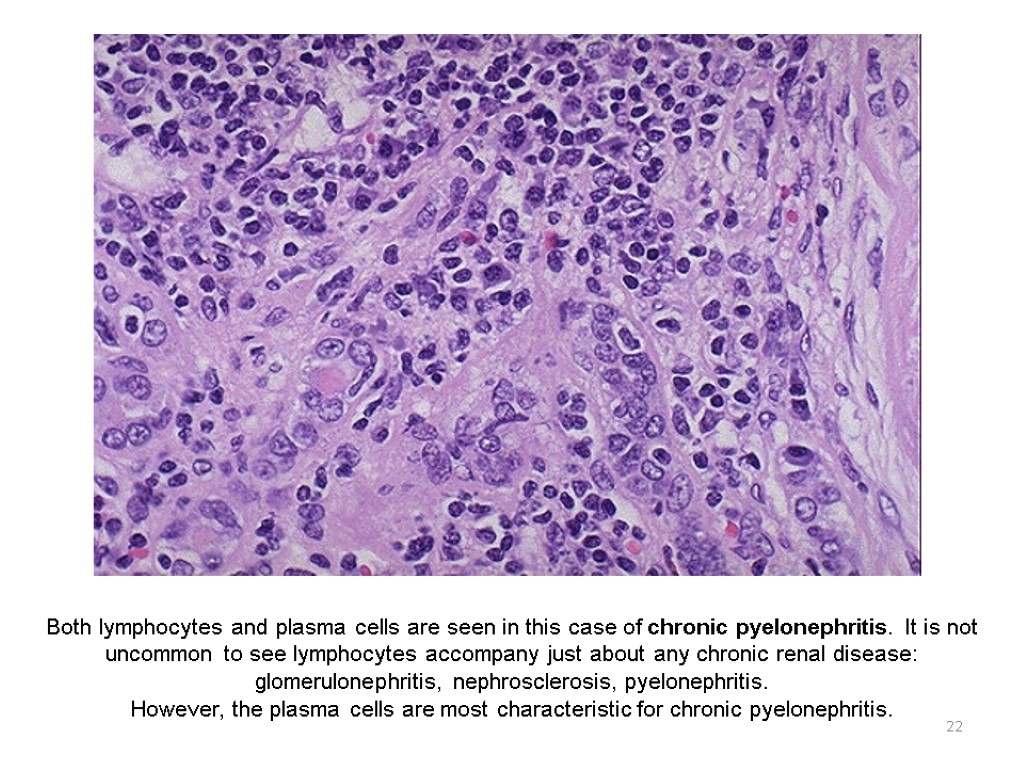 22 Both lymphocytes and plasma cells are seen in this case of chronic pyelonephritis.